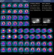 An example of a SPECT scan of the same patient using traditional full-time image acquisition.