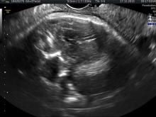 Zika ultrasound assessment, Zika virus, imaging zika, radiology of Zika, medical imaging of zika,