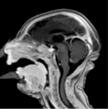 Zika virus, imaging zika, CT scans of Zika, MRI scans of zika, radiology of Zika, medical imaging of zika