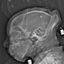 Zika virus, imaging zika, CT scans of Zika, MRI scans of zika, radiology of Zika, medical imaging of zika