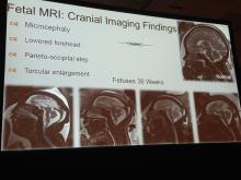 Zika virus, imaging zika,  radiology of Zika, medical imaging of zika