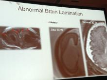 Zika virus, imaging zika,  radiology of Zika, medical imaging of zika