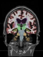 Gadolinium based contrast dye in brain MRI 
