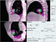 symmetry baseline shift, elekta treatment plan, VMAT, tomotherapy
