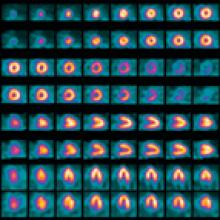PET vs. SPECT, nuclear imaging advances, Flurpiridaz F-18