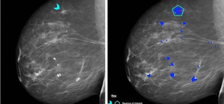  False-positive interpretations can result in women without cancer undergoing unnecessary imaging and biopsy. 