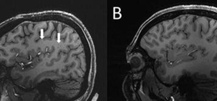 Figure 4. (A) Enlarged centrum semiovale (CSO) perivascular spaces (PVS) (arrows) on sagittal T1-weighted MRI in a case with chronic migraine. (B) Migraine-free control without enlarged CSO PVS.