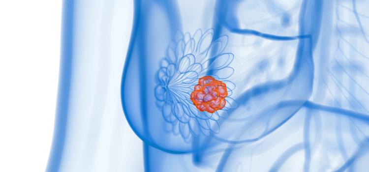 Targeted Radioimmunotherapy Regimen Achieves Complete, Durable Response in Breast Cancer Model