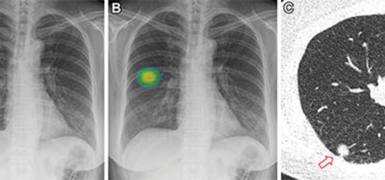 Using a single chest X-ray, a new AI tool can identify non-smokers who are at high risk for lung cancer