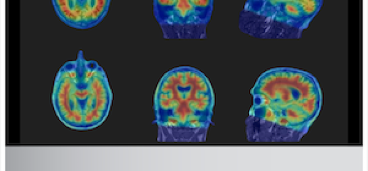 FDA Clears Cortechs.ai's NeuroQuant PET 