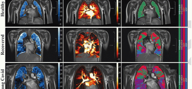 Free-breathing phase-resolved functional lung (PREFUL) low-field MRI at 0.55T with calculated parameters at an axial plane after automatic registration to a mid-expiration position and lung parenchyma segmentation. From left to right, representative color-coded images of functional show ventilation defects (VDP, blue), perfusion defects (QDP, red), ventilation/perfusion (V/Q match, green), ventilation/perfusion defects (V/Q defect, purple) in a healthy control (upper row, 7-year-old male), a participant rec