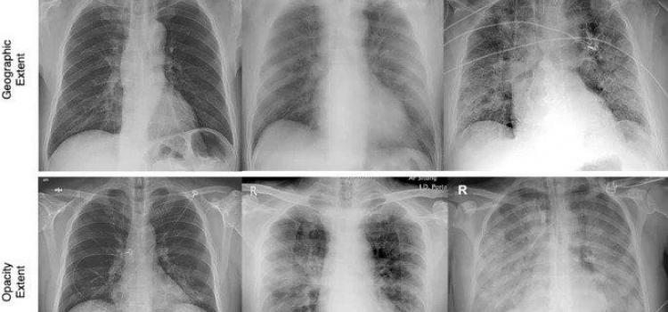 Chest X-rays used in the COVID-Net study show differing infection extent and opacity in the lungs of COVID-19 patients. Image courtesy of University of Waterloo