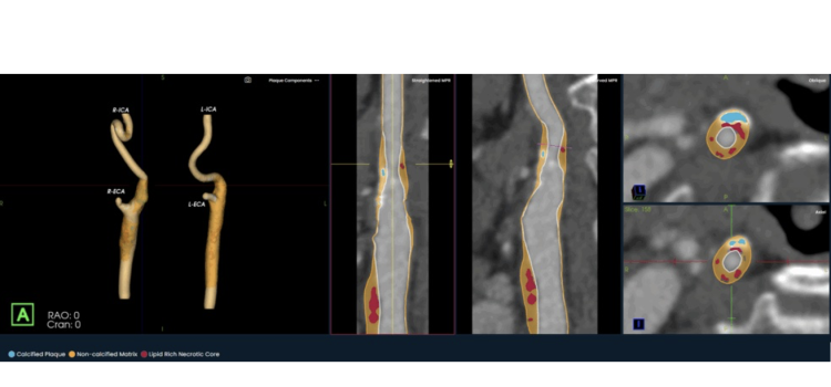 Image Analysis Software for the Carotid Arteries Now Available