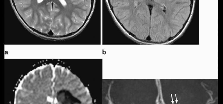 COVID-19 brain imaging