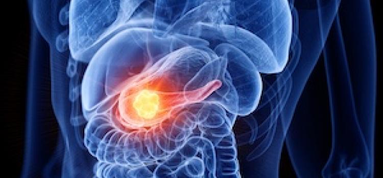 Pancreatic Cancer GettyImages-1190674453_0