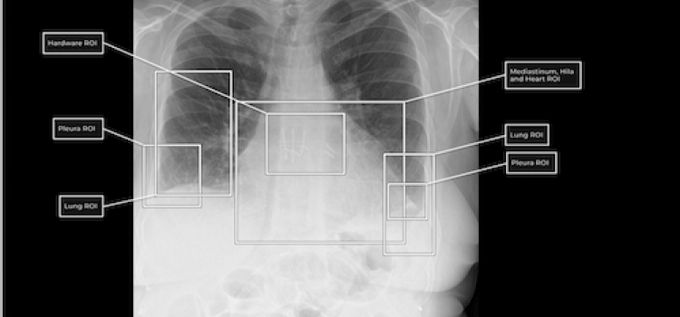 chest, x-ray, FDA, lung, Qure.ai
