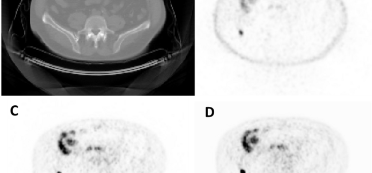 Representative axial image from a test set imaging study. From top left to bottom right: CT (A), NAC-PET (B), original AC-PET (C), AI-generated AC-PET (D). The blue arrow indicates one lesion that was observed in both images, and the red arrow indicates a lesion that was missed (i.e., not de-tected by expert nuclear medicine physicians) in AI image. NAC = Non-Attenuation Corrected. AC = Attenuation-Corrected