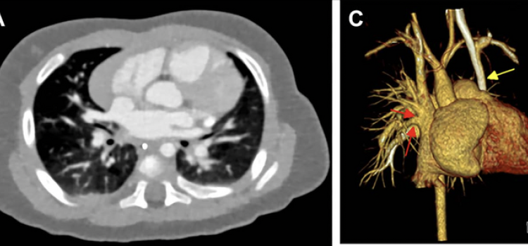 Cardiac photon-counting CT (PCCT) in a 174-day-old male infant with complex congenital heart defect. 
