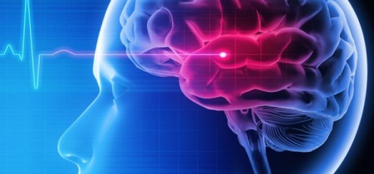 Rapid Response Teams Expedite Stroke Imaging, Treatment