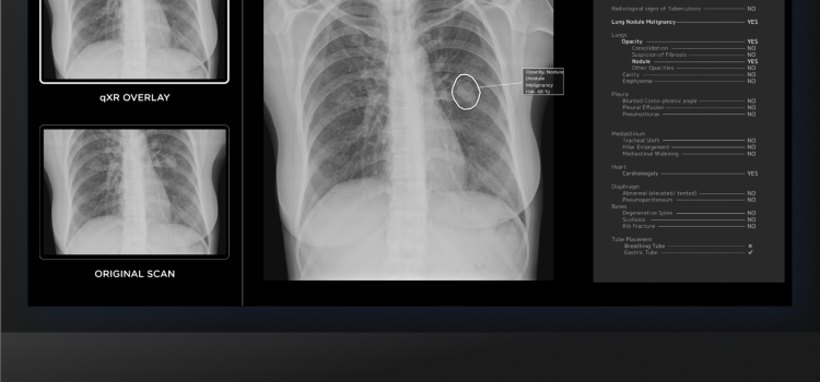 Qure’s qXR has now been cleared to triage pneumothorax (PTX) and pleural effusion (PE), which present severe challenges in emergency rooms and intensive care units (ICUs)